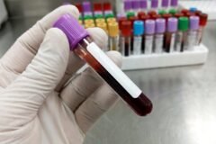 Novo exame de sangue capaz de detectar mais de 50 tipos de câncer chega ao Brasil no Hospital Israelita Albert Einstein